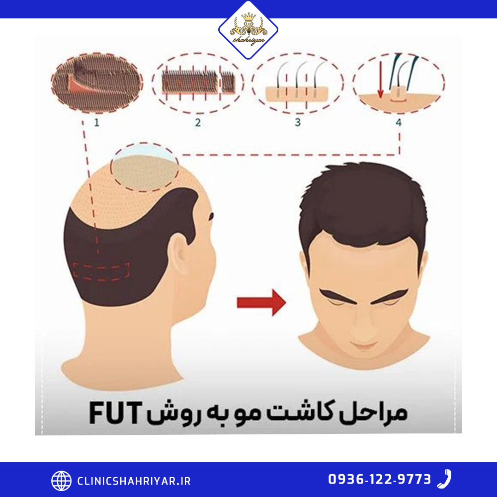 مراحل کاشت مو به روش FUT