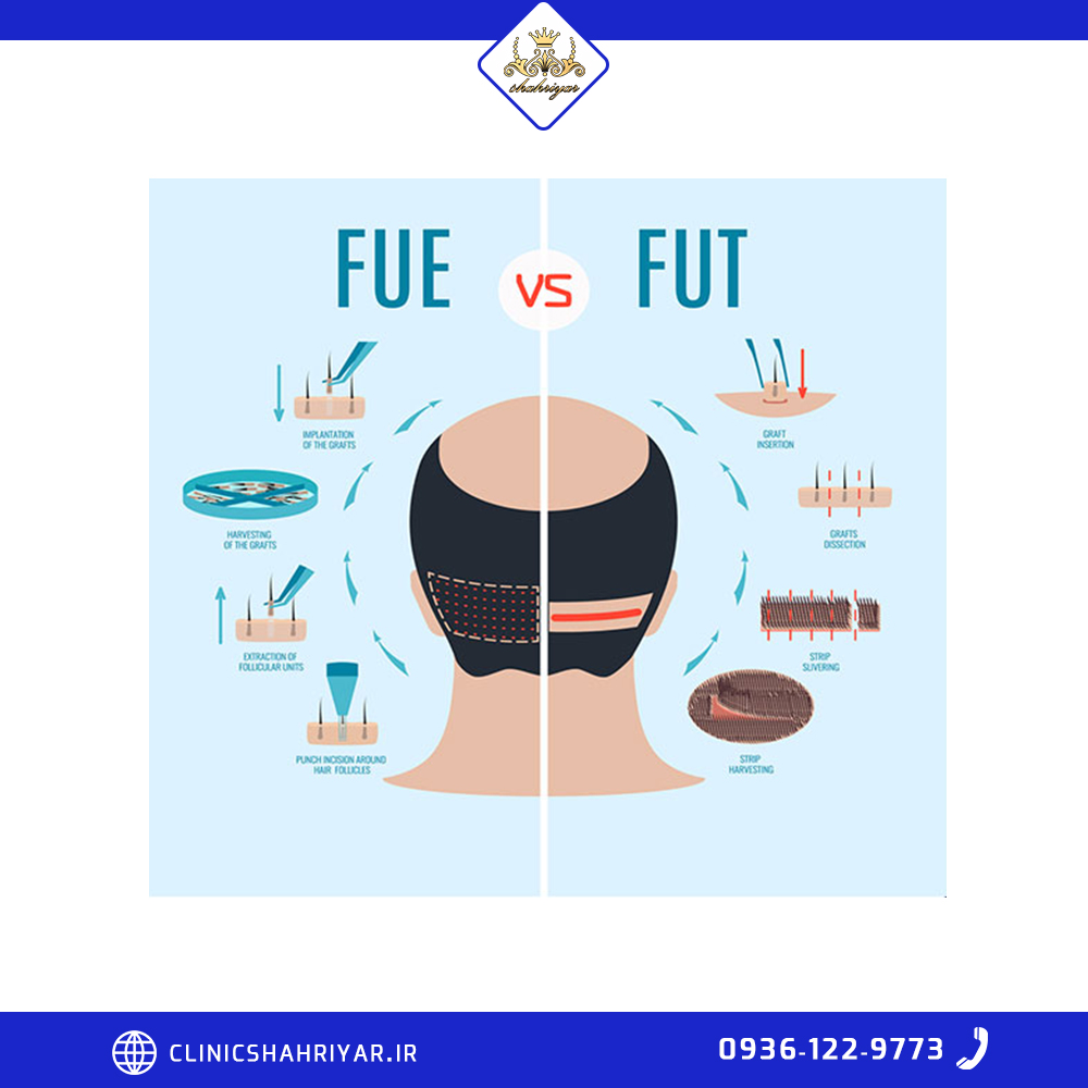 روش FUE (Follicular Unit Extraction)