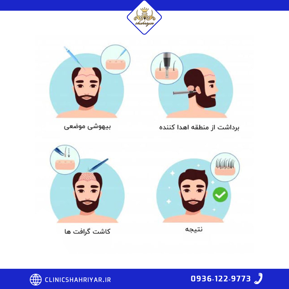 روش های کاشت مو ترکیبی