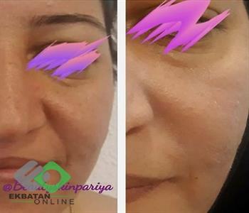 مرکز لاغری و لیزر پریا | لیزر در اکباتان 1