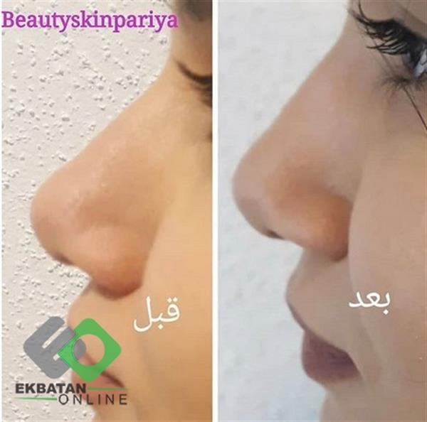 مرکز لاغری و لیزر پریا | لیزر در اکباتان 3