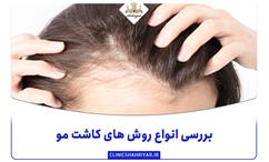 بررسی انواع روش های کاشت مو
